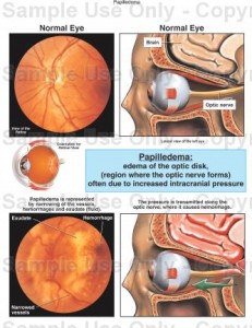 pictures of Papilledema