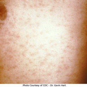 photos of Pityriasis Rosea