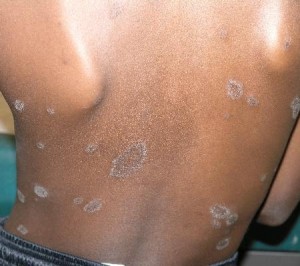 picture of Pityriasis Rosea