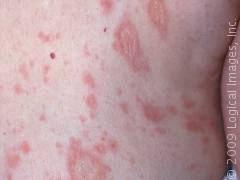 pictures of Pityriasis Rosea