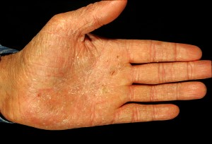 pompholyx eczema