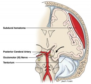 Subdural Hematoma picture