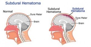 photos of Subdural Hematoma