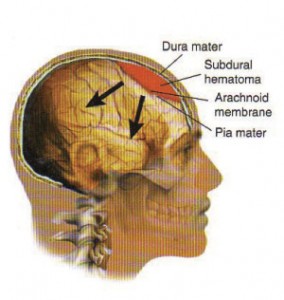 pictures of Subdural Hematoma