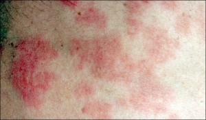 Sun Poisoning Rash Images