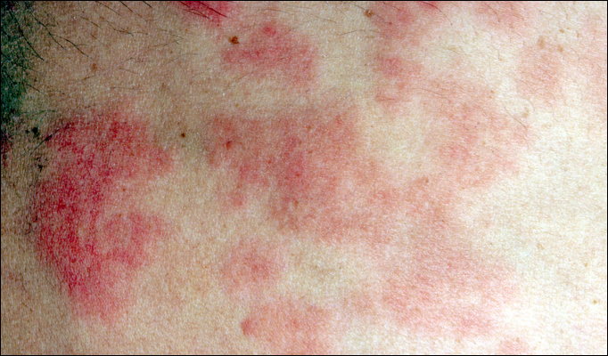 Sun Poisoning Rash Pictures Symptoms Causes And Treatment