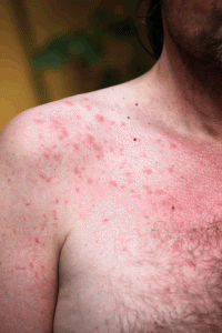 Pictures of Sun Poisoning Rash