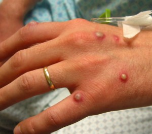 pictures of vesicular rash