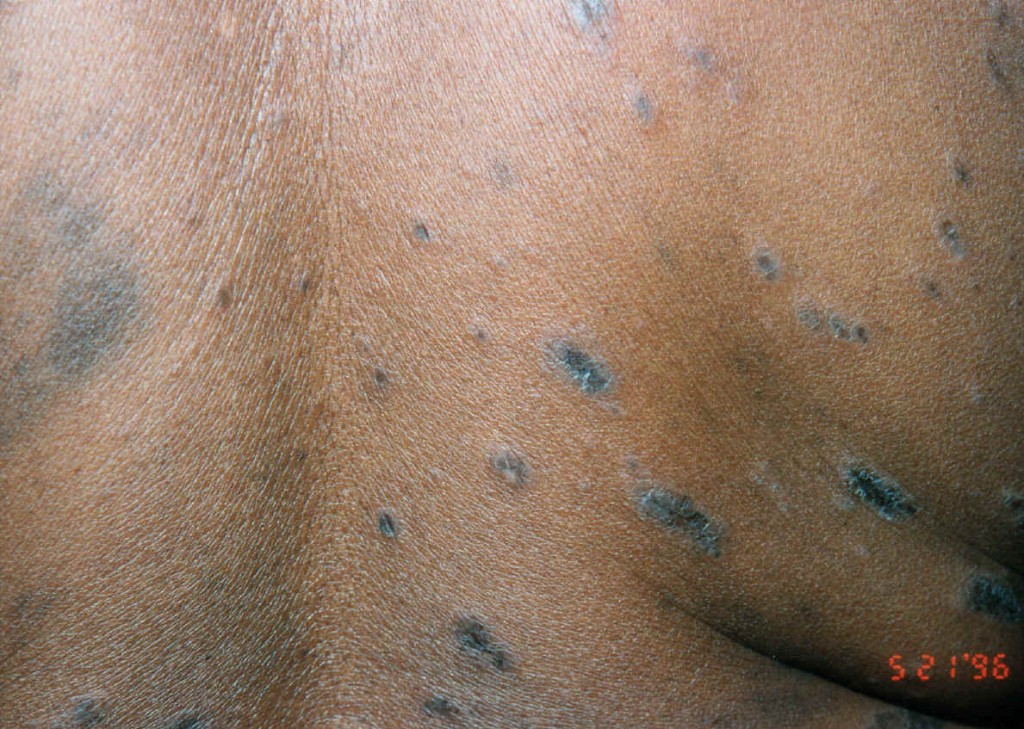 Pityriasis Rosea Pictures, Causes, Symptoms and Treatment