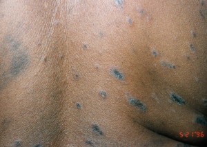 Pityriasis Rosea images