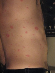 Pityriasis Rosea photos