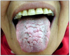 Geographic Tongue pictures
