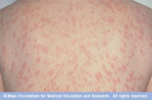 Pityriasis Rosea