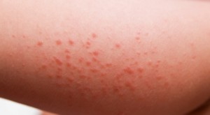 skin rashes pictures