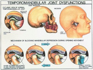 tmj pictures