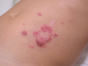 Bullous Impetigo images