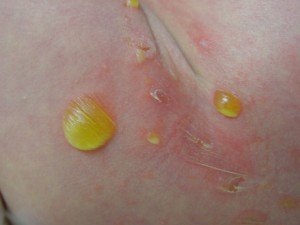 photos of Bullous Impetigo