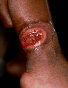 Cutaneous Leishmaniasis pictures