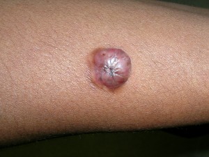 Dermatofibrosarcoma Protuberans images