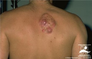 pictures of Dermatofibrosarcoma Protuberans