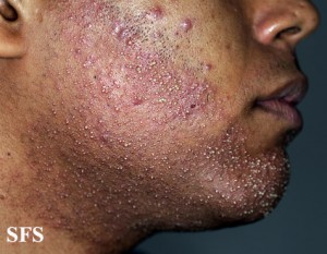 Eosinophilic Folliculitis pictures