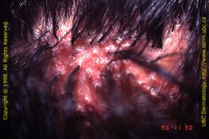 Folliculitis Decalvans pictures