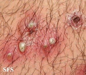 photos of Folliculitis