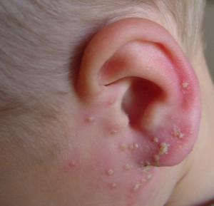 pictures of Folliculitis