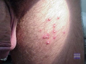 Folliculitis images