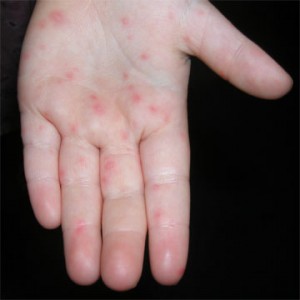 images of Hand Foot and Mouth Disease