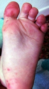 photos of Hand Foot and Mouth Disease