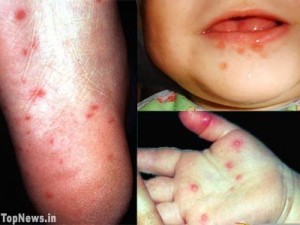 pictures of Hand Foot and Mouth Disease