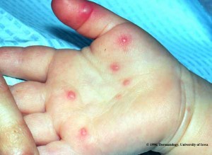 Hand Foot and Mouth Disease children pictures