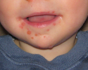Hand Foot and Mouth Disease in Children pictures