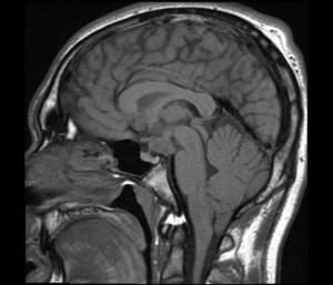 Hypothalamic Hamartoma pictures