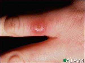 Leishmaniasis pics