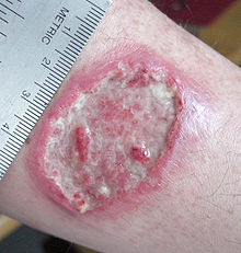 images of Leishmaniasis