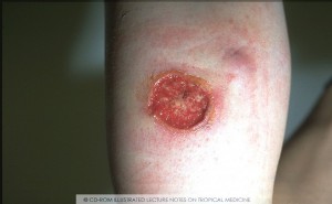 pictures of Leishmaniasis