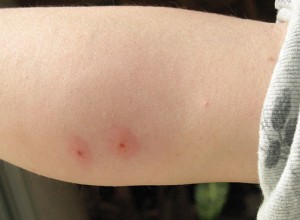 photos of mosquito bites