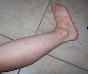 pictures of mosquito bites
