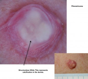 Pilomatrixoma images