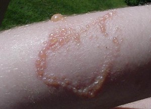 images of Poison Ivy Rash