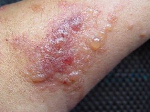 Pictures of Poison Ivy Rash