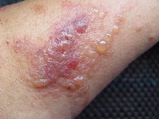 Poison Ivy Rash - Pictures, Causes, Contagiousness, Duration and Treatment