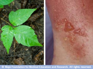 poison ivy plant and rash
