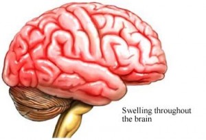 symptom of Rift Valley Fever