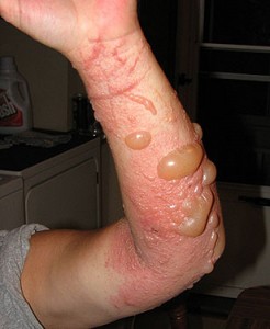 severe Poison Ivy Rash pictures