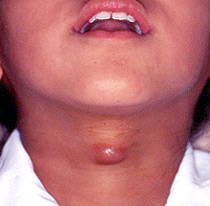 Thyroglossal Cyst Pictures
