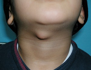 Thyroglossal Duct Cyst Photos