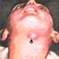 Pictures of Thyroglossal Duct Cyst